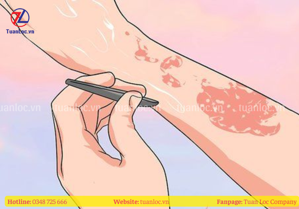 Dùng nhíp nhổ sợi thủy tinh ra khỏi da