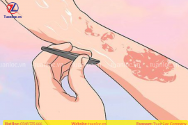 Mách bạn cách xử lý khi sợi thuỷ tinh tiếp xúc da gây ngứa